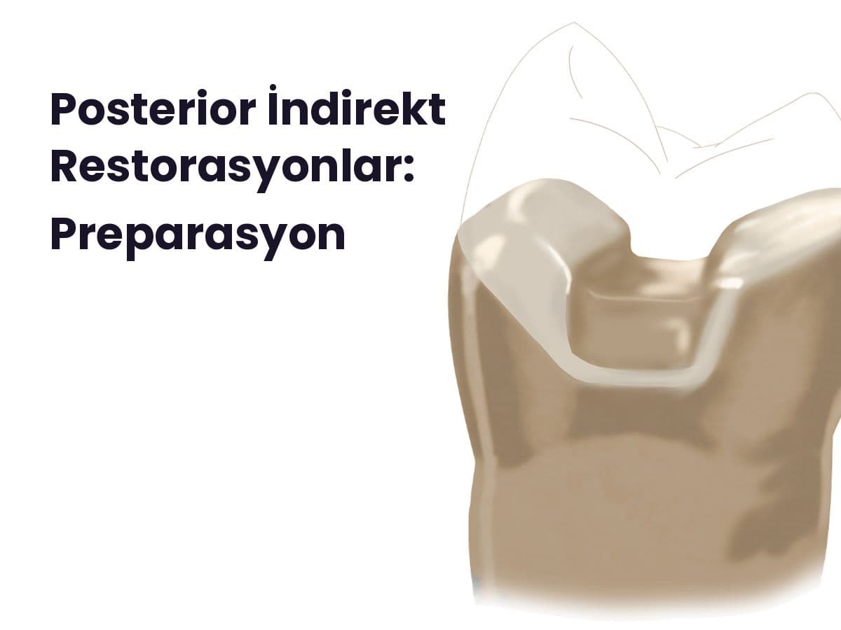 Posterior İndirekt Restorasyonlar: Preparasyon