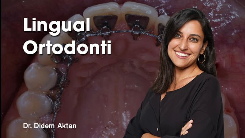 Lingual Ortodonti: Kişiye Özel Estetik ve Biyolojik Avantajlar