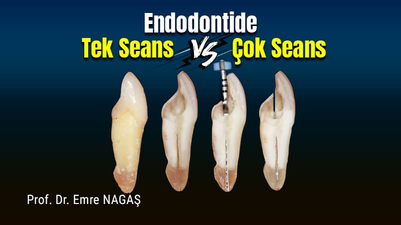 Endodontide Tek Seans vs Çok Seans