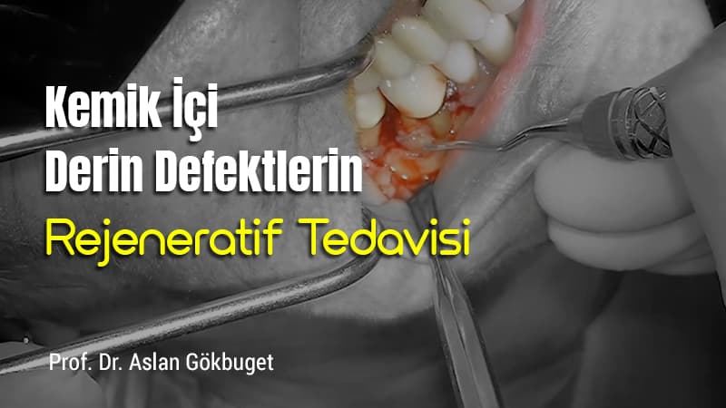 Kemik İçi Derin Defektlerin Rejeneratif Tedavisi