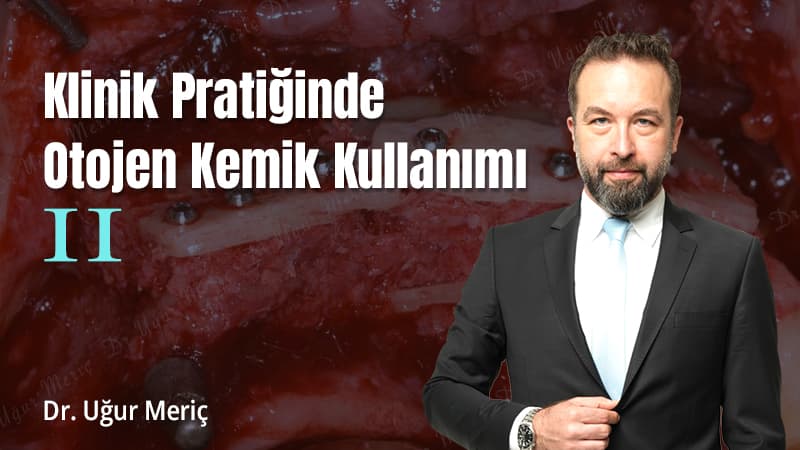 Klinik Pratiğinde Otojen Kemik Kullanımı - II