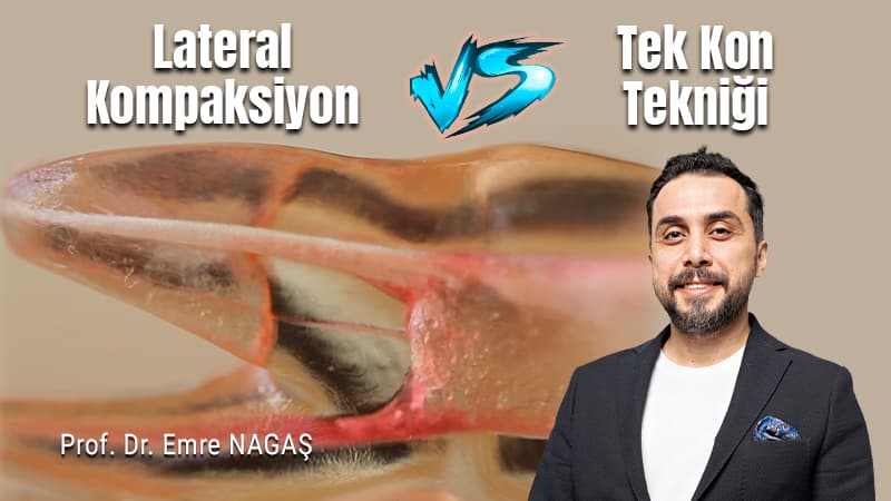 Lateral Kompaksiyon vs Tek Kon Tekniği