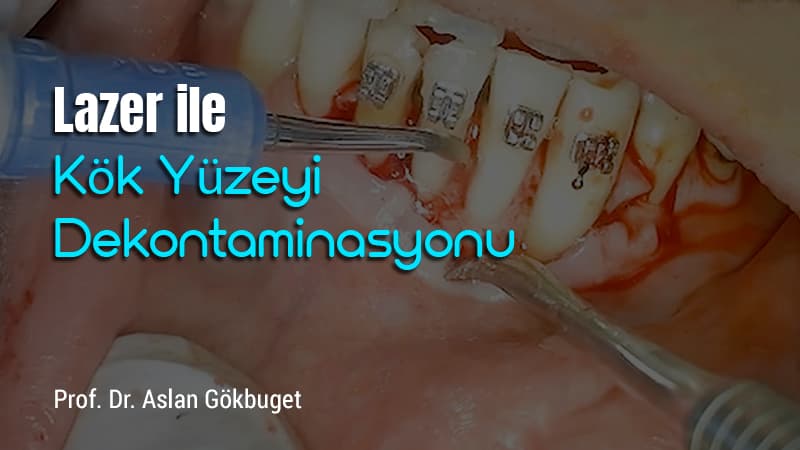 Lazer ile Kök Yüzeyi Dekontaminasyonu