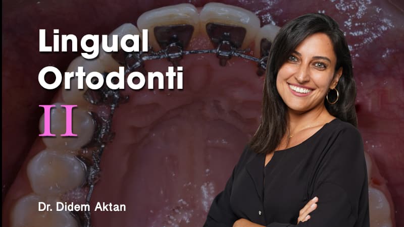 Lingual Ortodonti - II