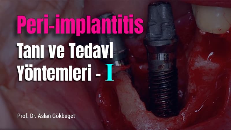 Peri - implantitis Tanı ve Tedavi Yöntemleri - I