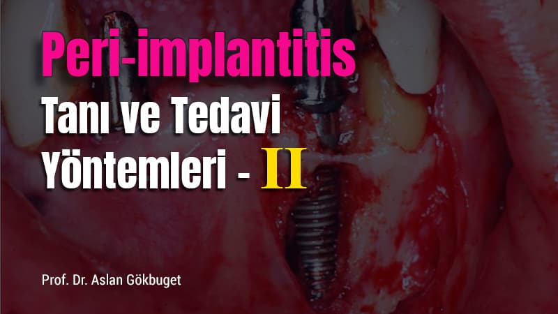 Peri - implantitis Tanı ve Tedavi Yöntemleri - II