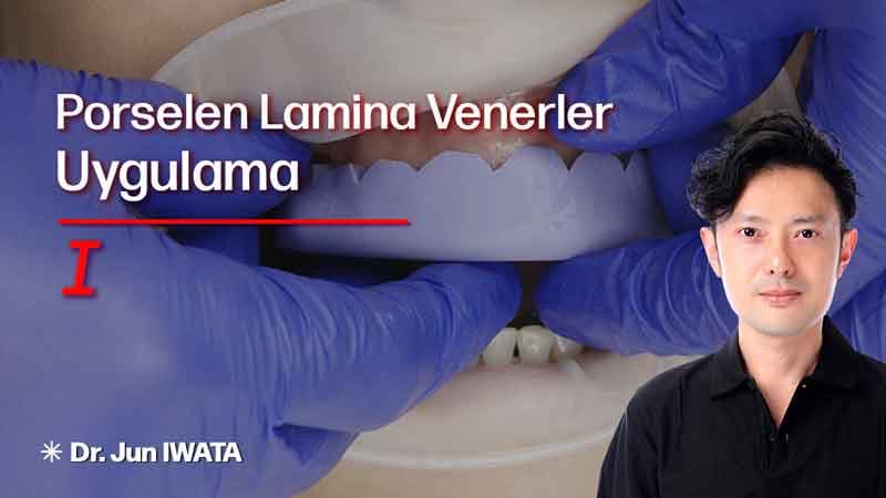 Porselen Lamina Venerler - Uygulama - I