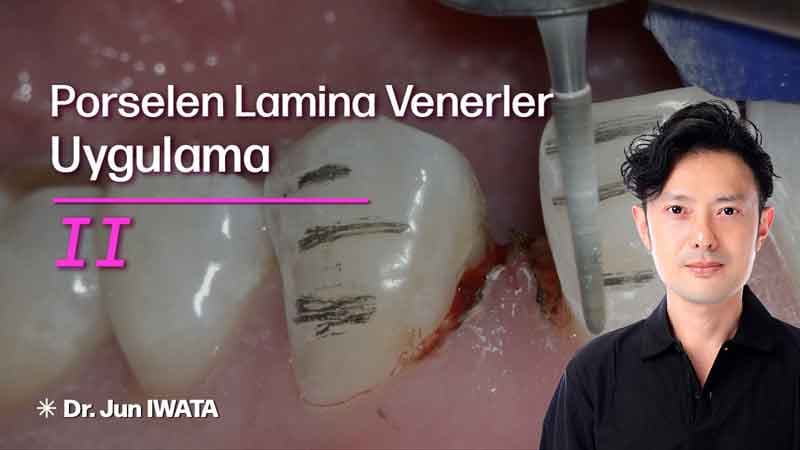Porselen Lamina Venerler - Uygulama - II