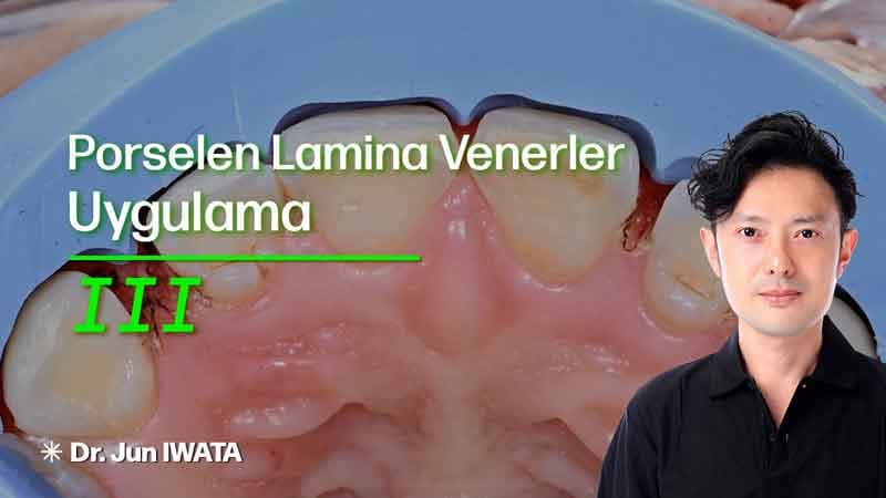 Porselen Lamina Venerler - Uygulama - III