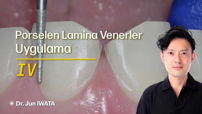 Porselen Lamina Venerler - Uygulama - IV