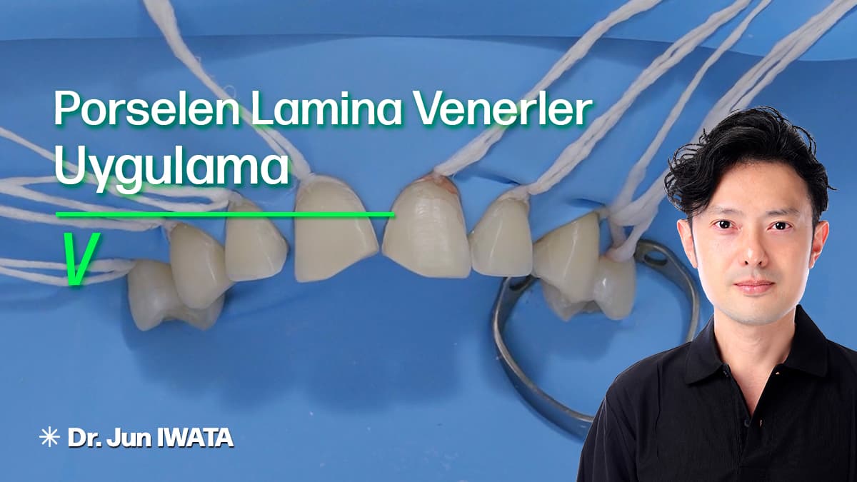 Porselen Lamina Venerler - Uygulama - V