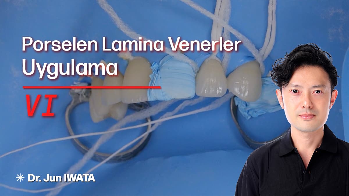 Porselen Lamina Venerler - Uygulama - VI