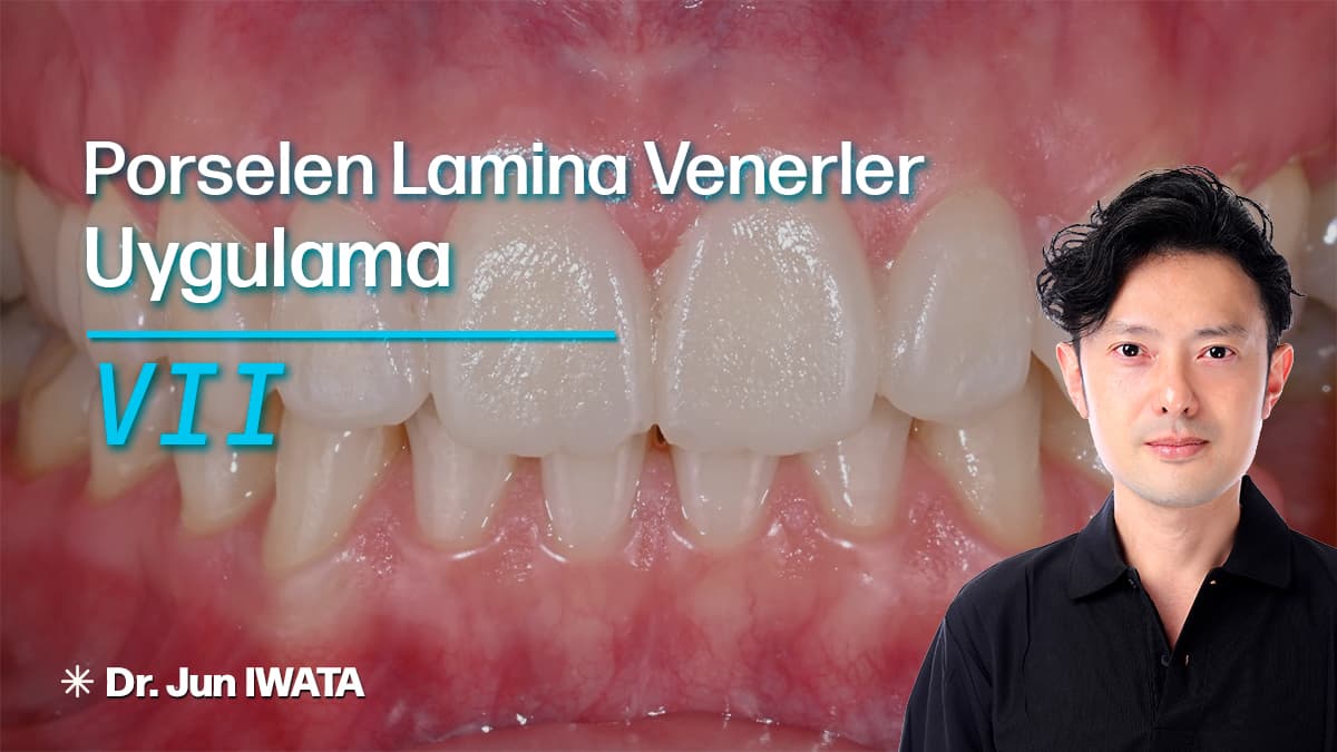 Porselen Lamina Venerler - Uygulama - VII