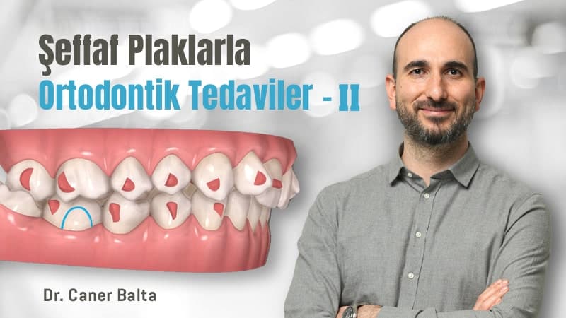 Şeffaf Plaklarla Ortodontik Tedaviler - II
